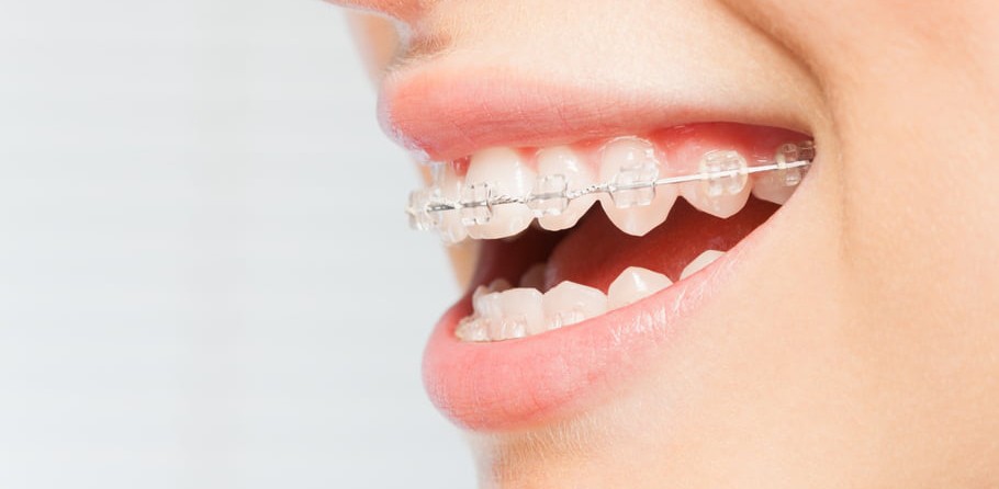 Orthodontie adulte